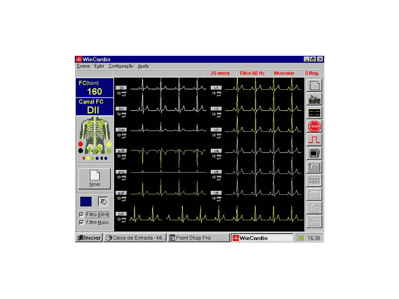 ecg